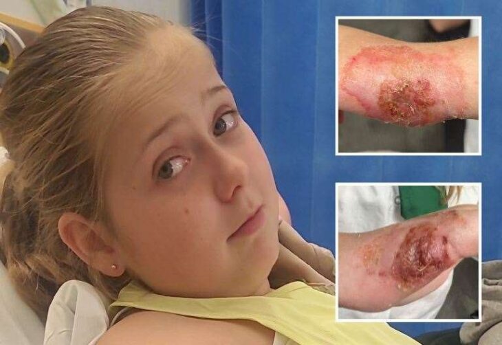 Temu-bought nail glue leaves Sheerness Oasis Academy pupil with nerve-damaging burns