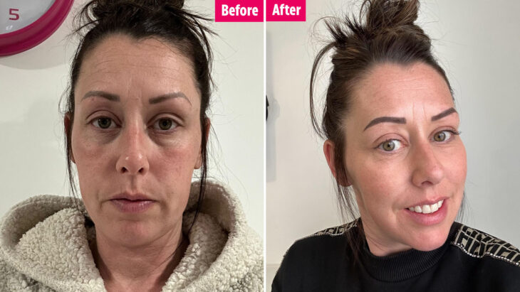 I tried to fix my dark under-eye bags with TikTok’s 23p viral hack - I’ve saved a fortune and will never use cream again