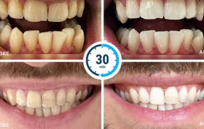 Shoppers can bag 'game-changing' whitener that leaves teeth brighter after one use for free